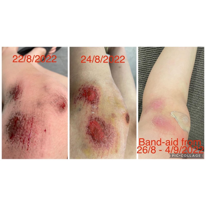 Băng Dán Vết Thương Band-Aid Advanced Healing Hydro Seal Jumbo 3 Miếng – Bảo Vệ & Hỗ Trợ Phục Hồi Vết Thương